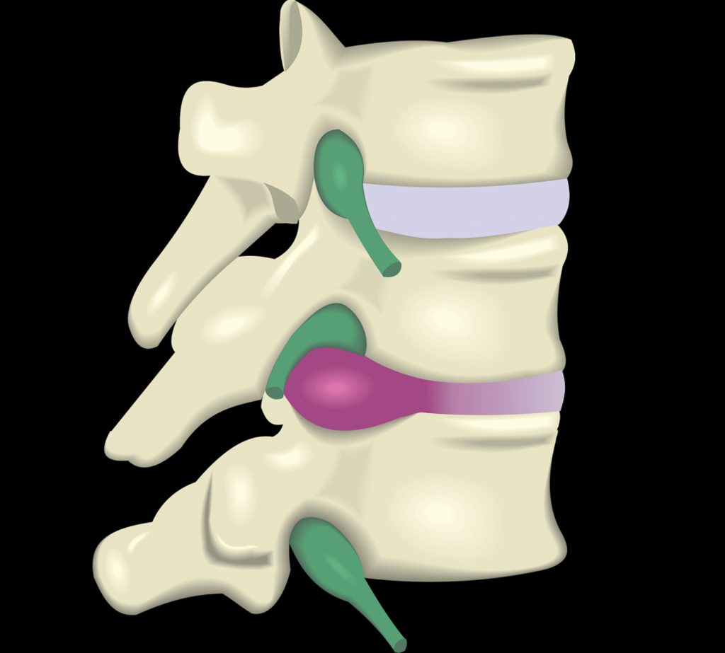 Bulging Disc – Spineology Chiropractic