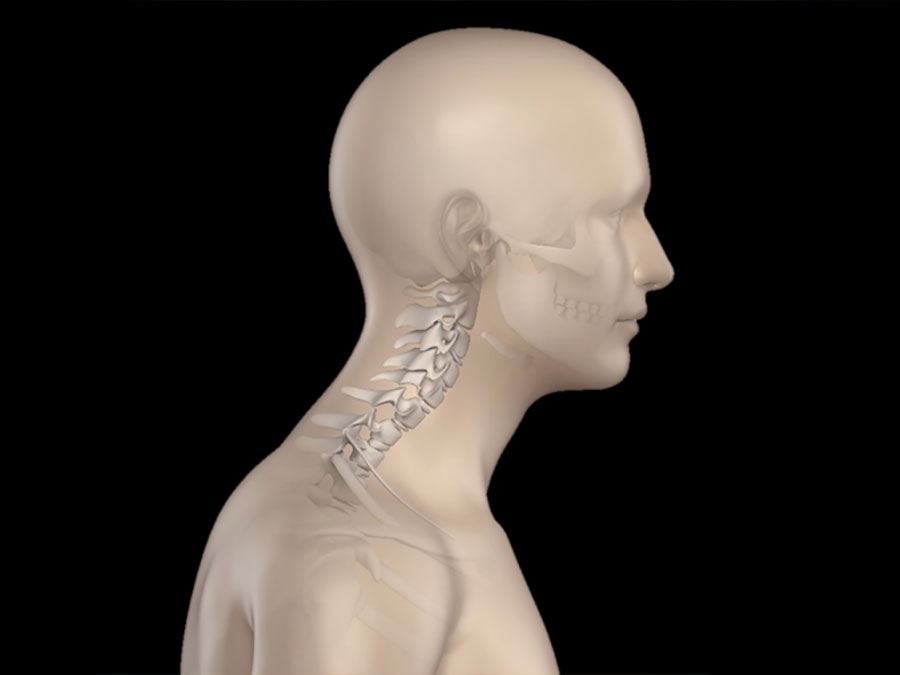 Forward head posture